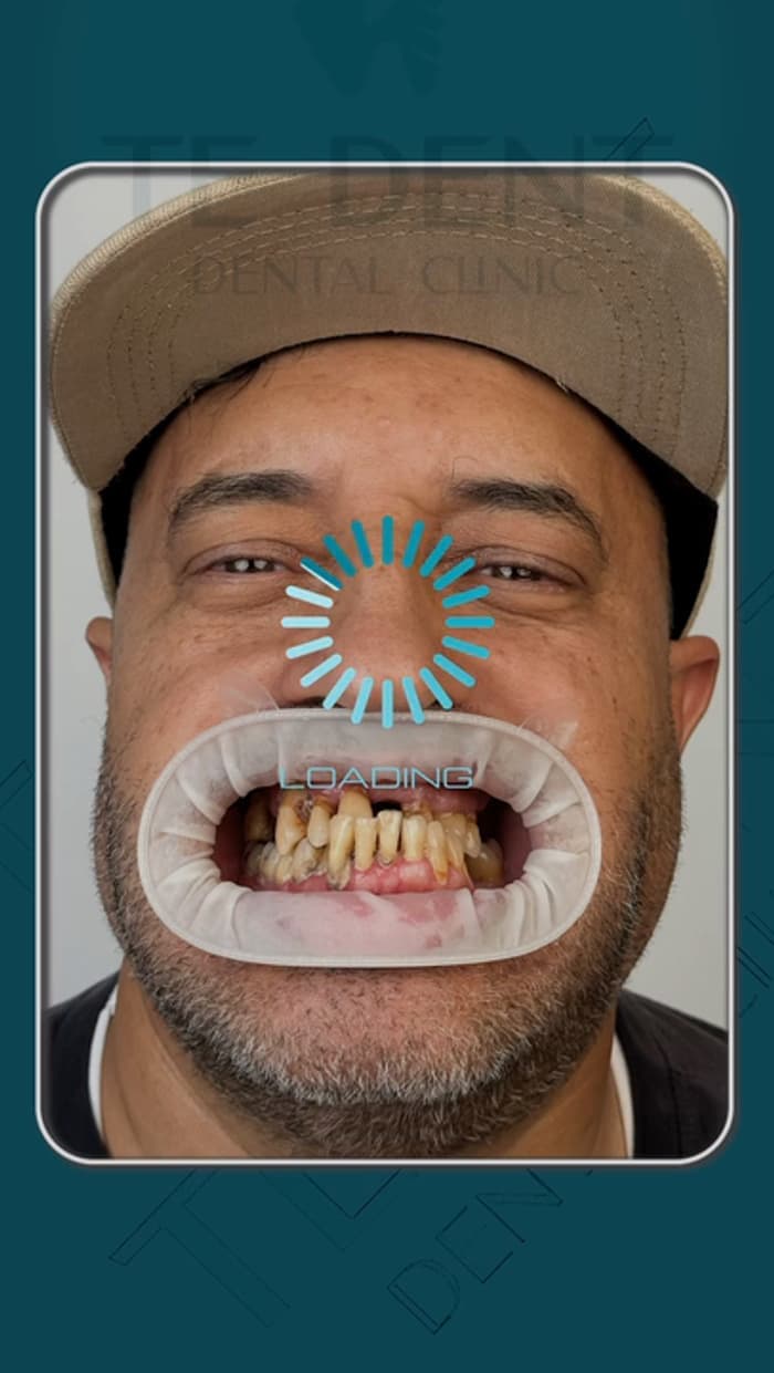 A patient's worn and discoloured upper and lower teeth before treatment, held open with a cheek retractor