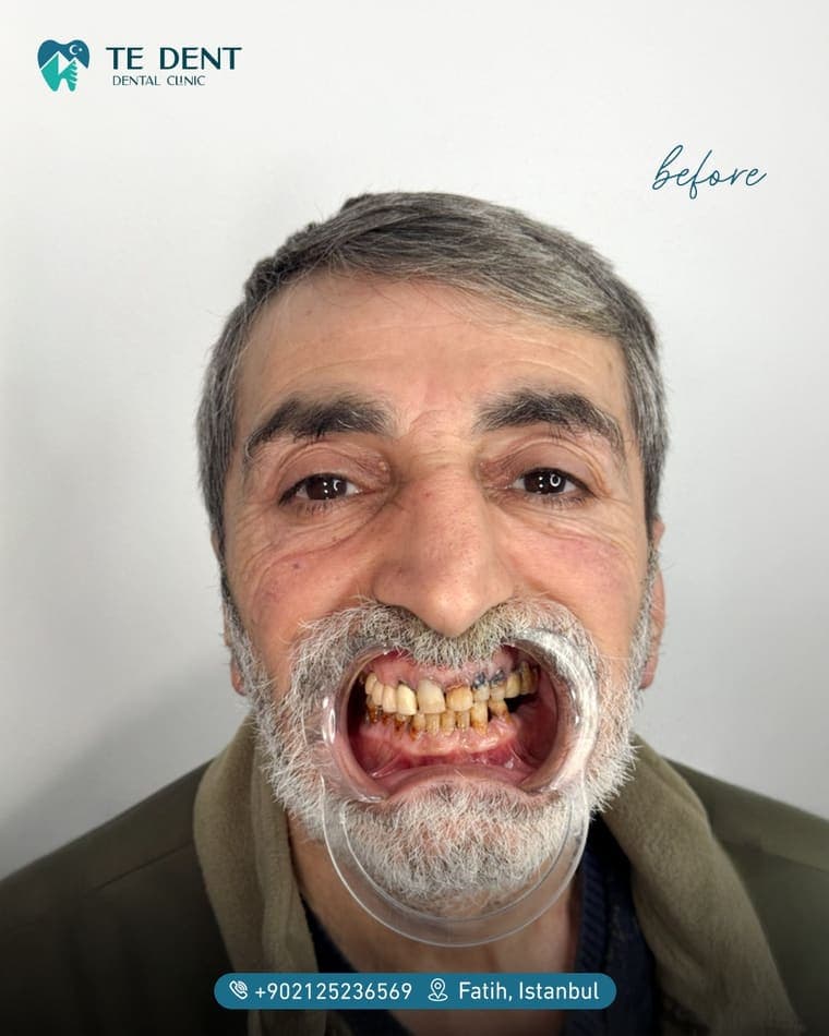 Anterior veneers — before treatment