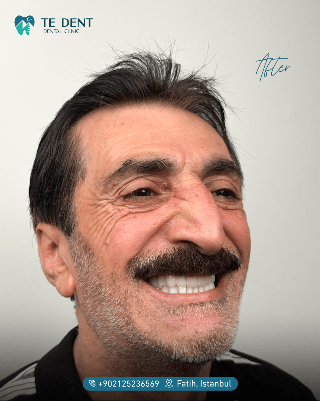 Anterior veneers — after treatment