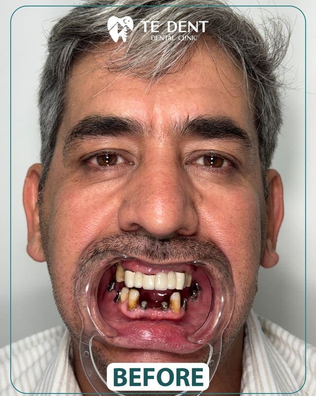 Dental implants — before treatment