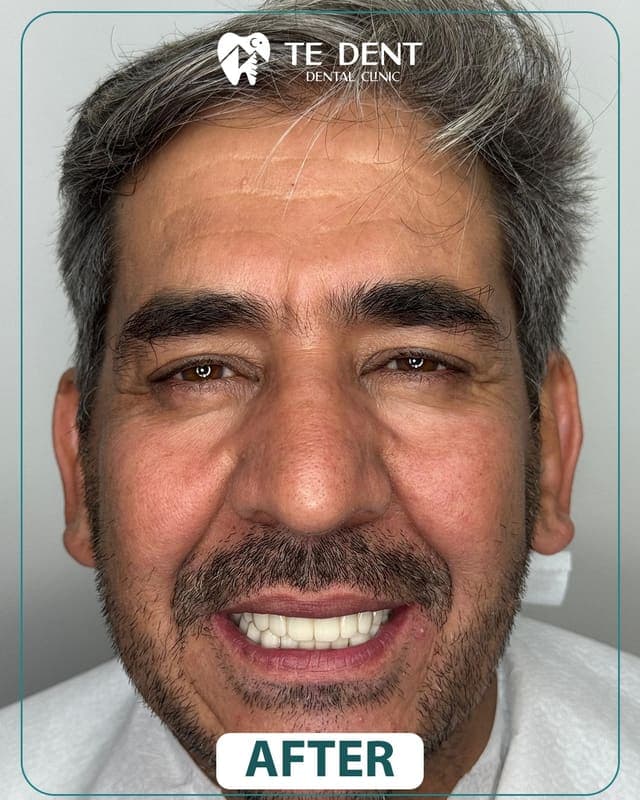 Dental implants — after treatment