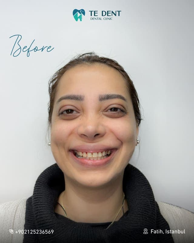 E-max veneers — before treatment