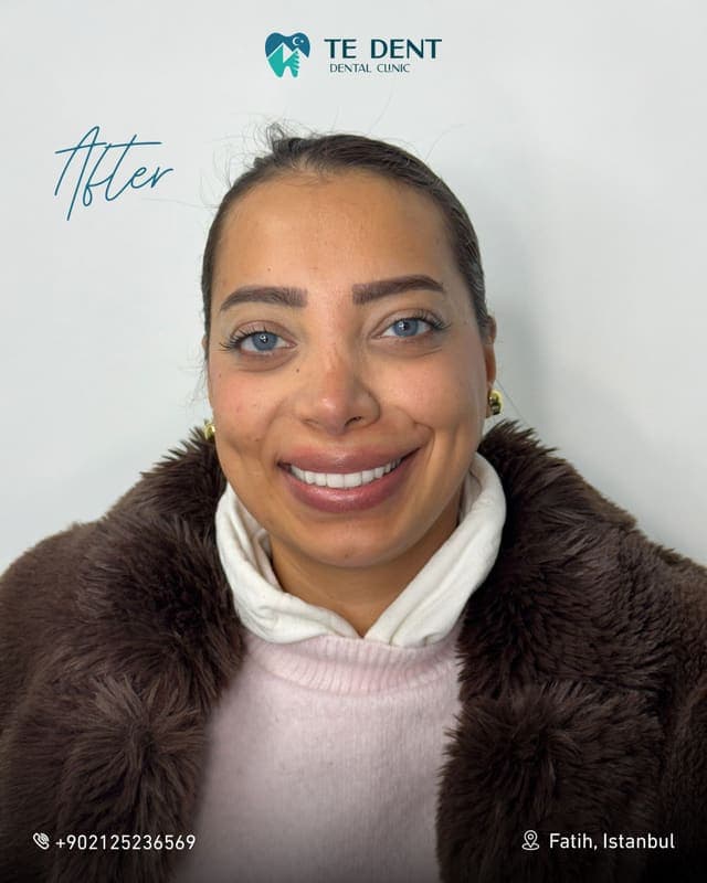 E-max veneers — after treatment