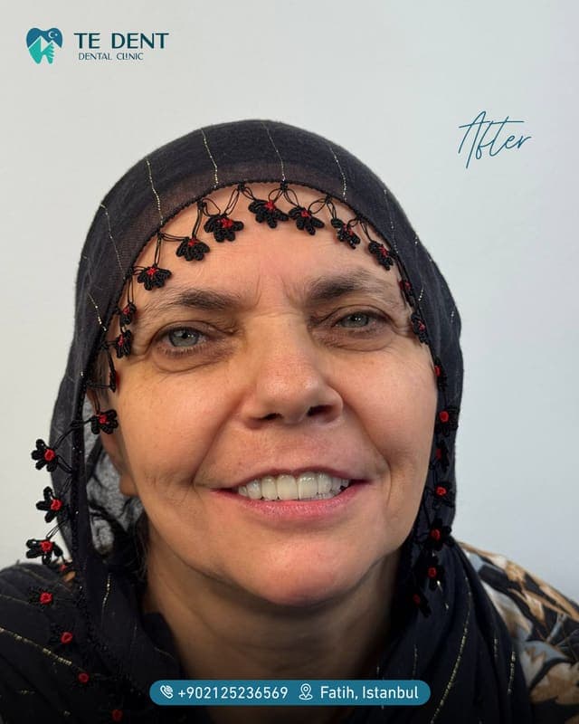 All-on-4 — after treatment