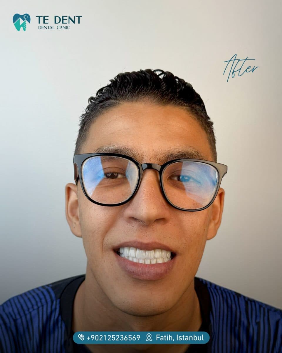 Full lower and upper restoration — after treatment