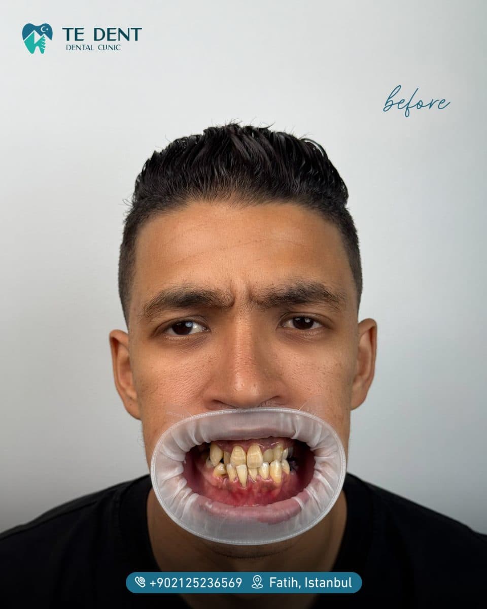 Full lower and upper restoration — before treatment