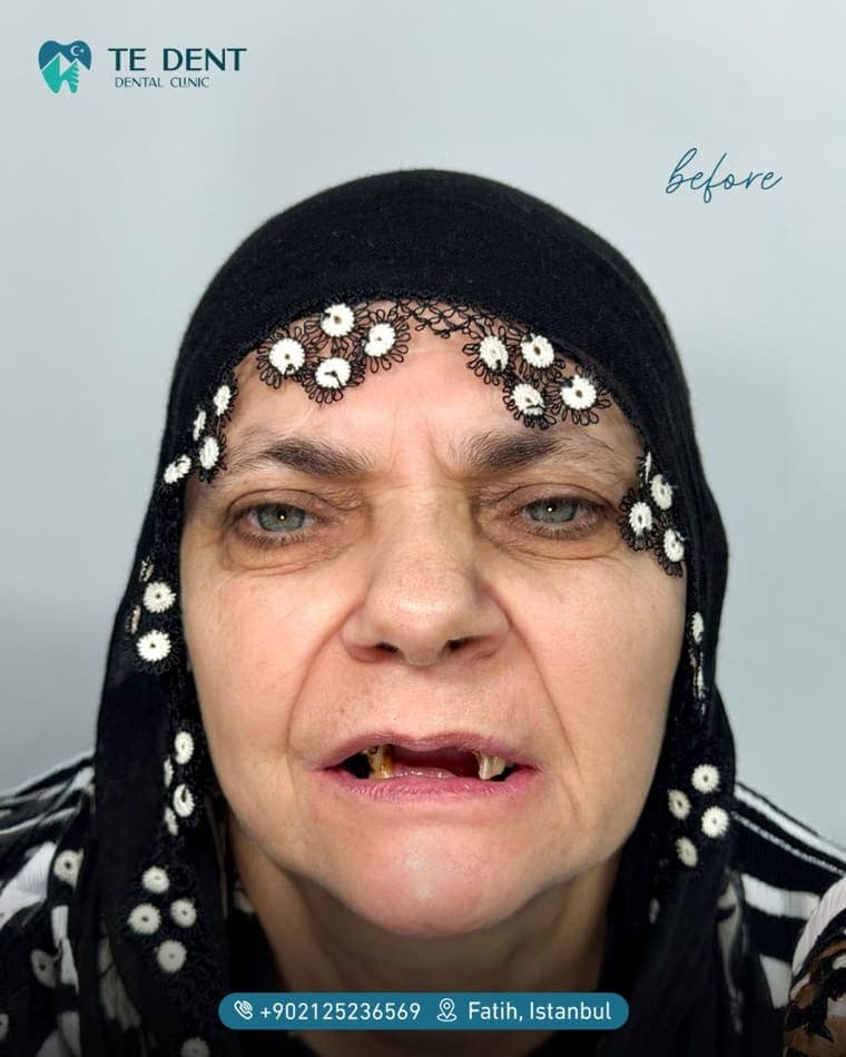 Implant-supported arch — before treatment