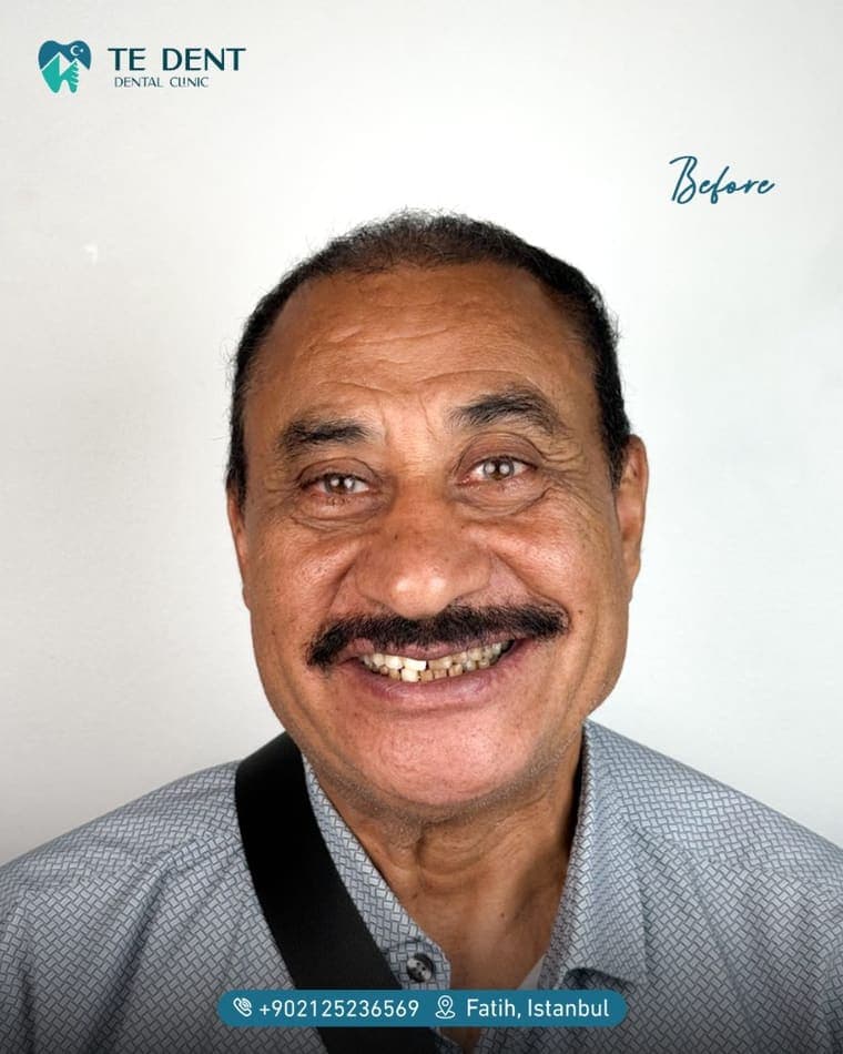 Full smile design — before treatment