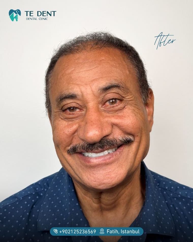 Full smile design — after treatment