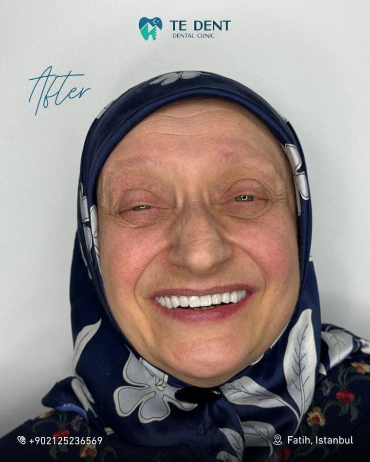 All-on-6 upper arch — after treatment