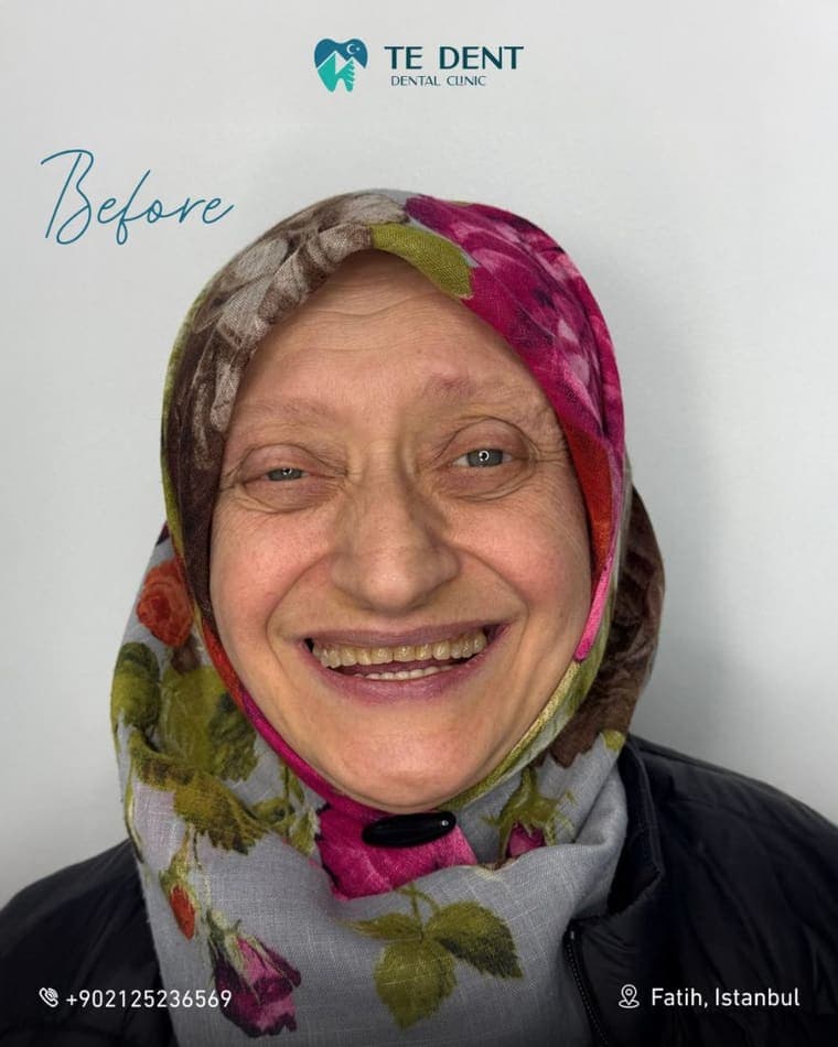 All-on-6 upper arch — before treatment