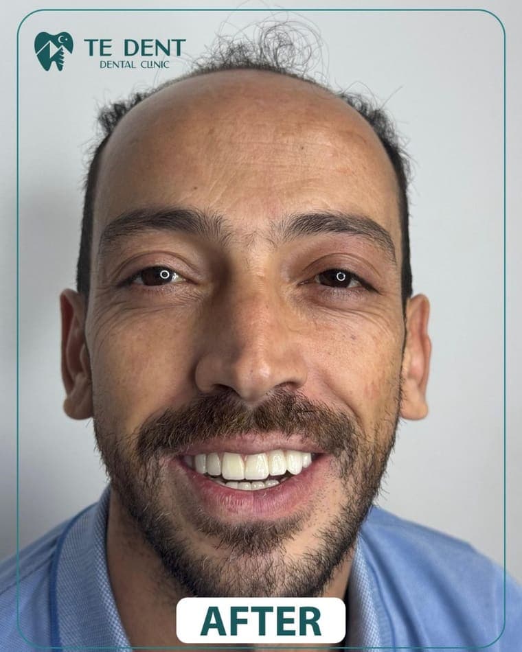 Crowns and veneers — after treatment