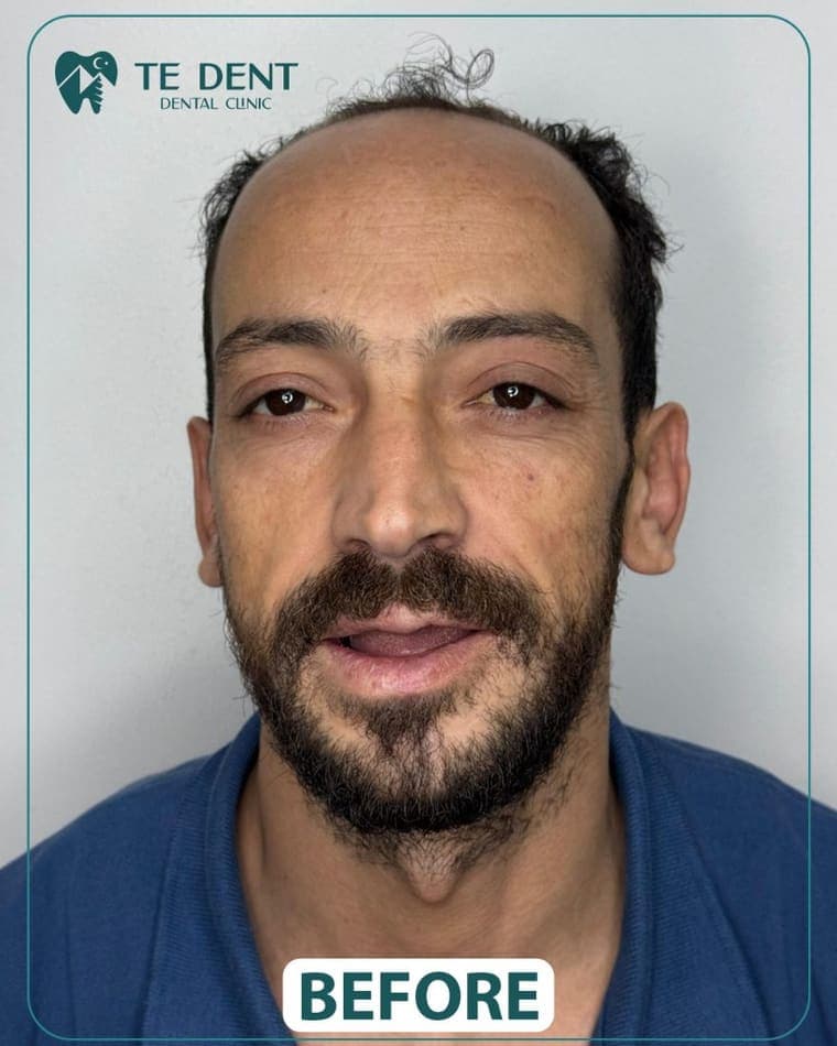 Crowns and veneers — before treatment